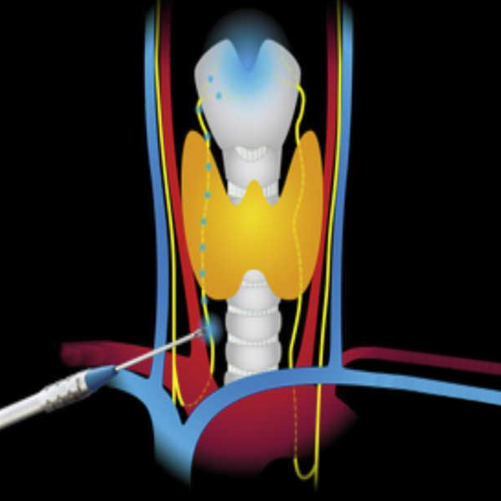 Thyroid Nerve Monitoring