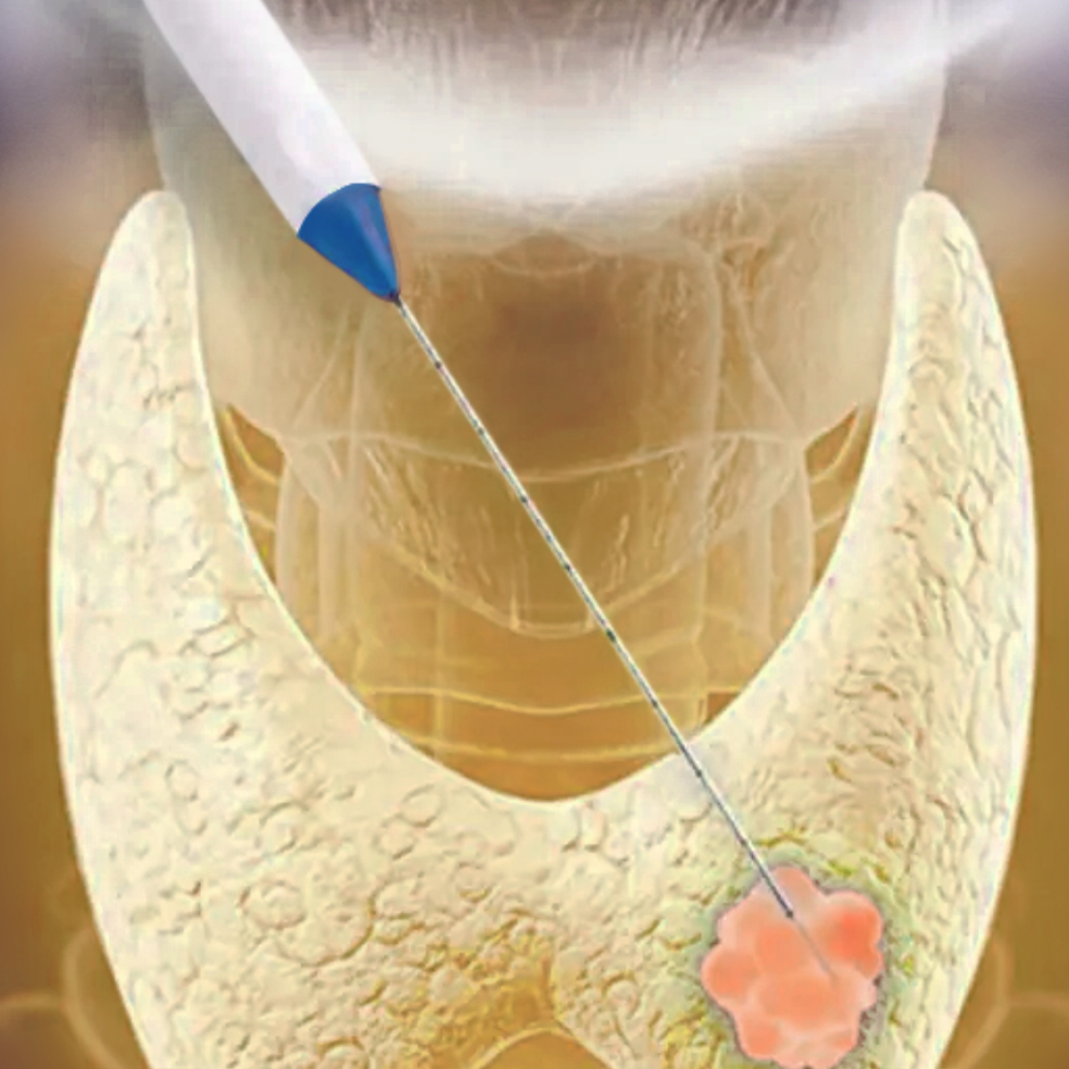 Radio Frequency Ablation